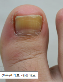 발톱 무좀