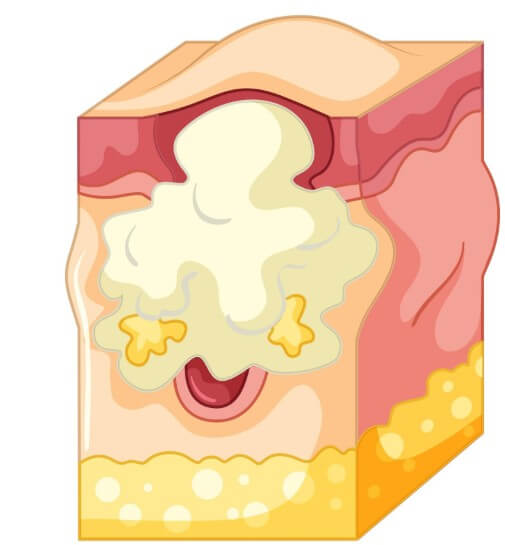 모공각화증 원인