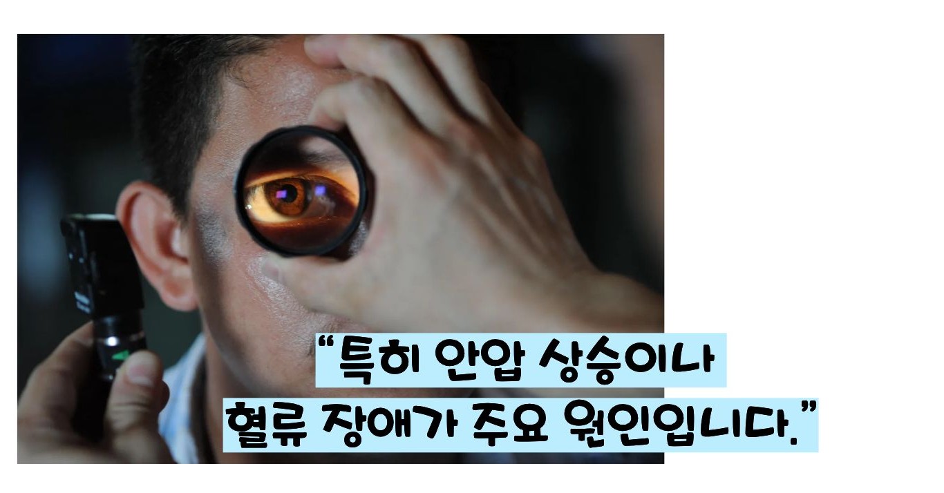 녹내장 초기증상