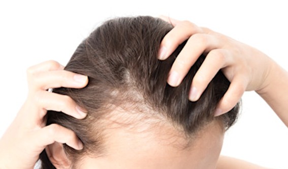 [탈모예방] 로게인(미녹시딜)과 로즈마리 오일, 함께 사용하면 효과가 더 좋을까?