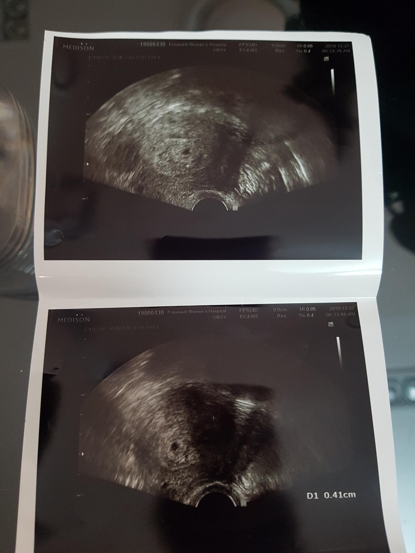 계류유산이란 아기집은 있지만 아기가 보이지 않거나 20주 이전에 아기가