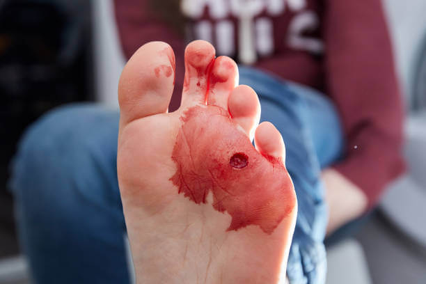 티눈 생기는 이유, 굳은살과 사마귀 차이 및 치료에 대해 알아봤습니다. 한번쯤은 손과 발에 티눈이 발생하는 것을 볼 수 있습니다. 티눈이 생기는 이유와 굳은살, 사마귀 차이점, 치료법, 티눈약 부작용 및 주의사항도 참고하시기 바랍니다.