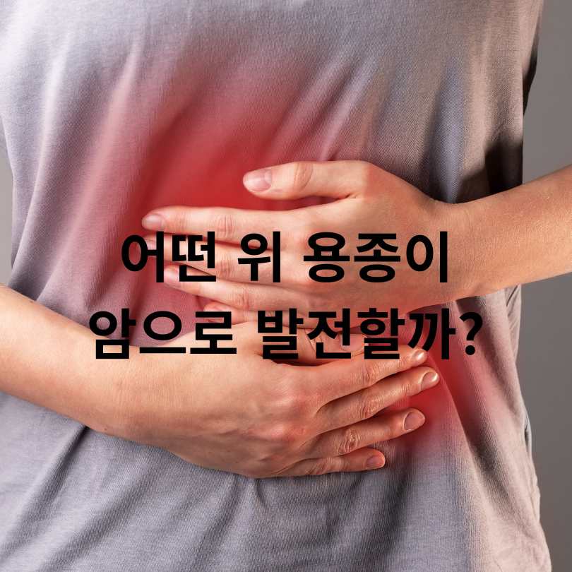 위 용종 암일확률? 걱정되는 분들을 위한 정확한 정보