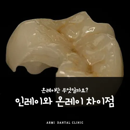 인레이 온레이의 차이와 치료 방법_6