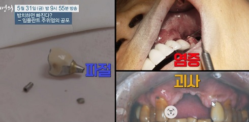 임플란트빠짐