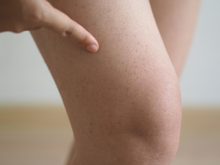 헤노호쉰라인 자반증은 혈관염의 유형이다.