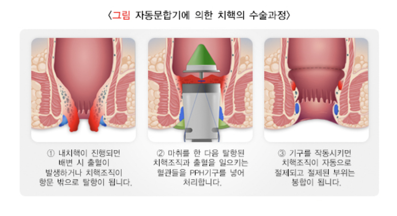 자동문합기를 이용한 치핵절제술