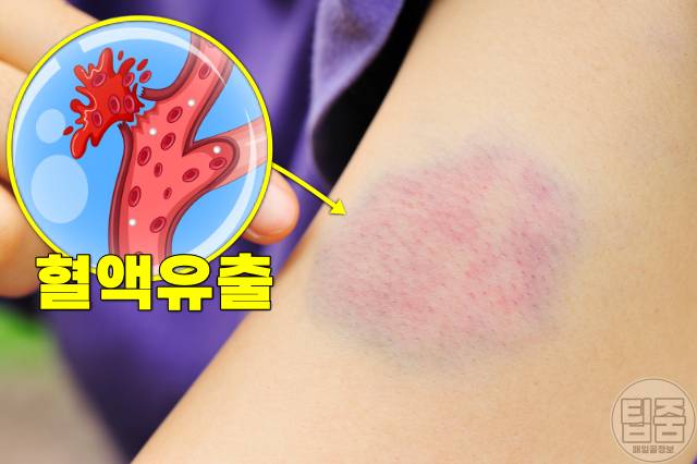 팔 다리 멍 자주 생기는 이유 멍원인 폰 빌레브란트병