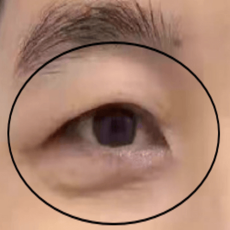 눈썹거상술 전 남성의 모습