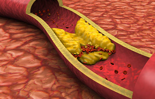 고지혈증에 좋은 음식 고지혈증 증상 고지혈증 약 부작용 고지혈증 수치 치료법