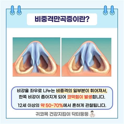 비중격만곡증수술