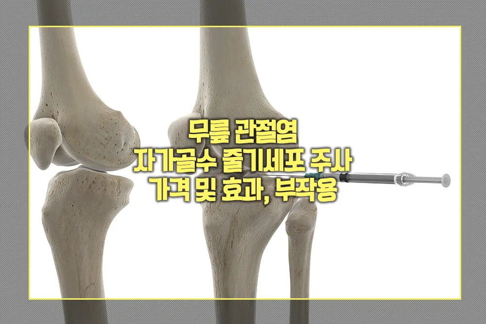 무릎 관절염 자가골수 줄기세포 주사 가격 및 효과, 부작용