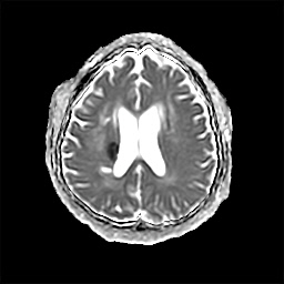뇌경색MRI