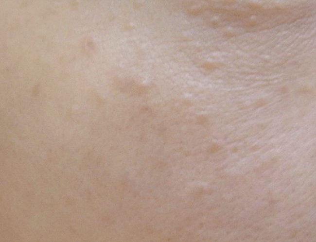 얼굴 편평사마귀 사진