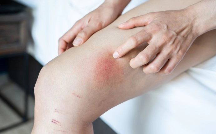 대상포진 허벅지 허리 팔 증상