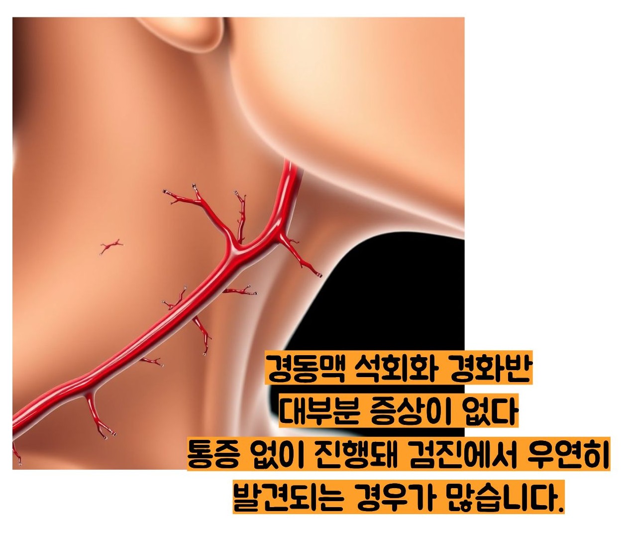경동맥 석회화 경화반