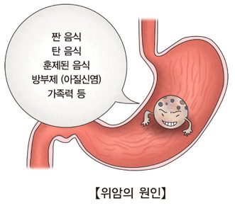 위암 증상