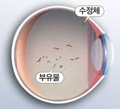 비문증