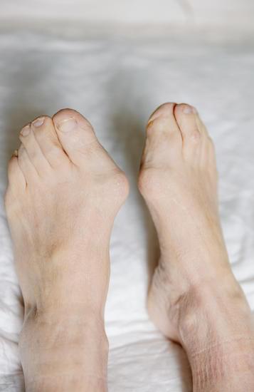 무지외반증 수술 │ 휘어진 엄지발가락, 수술로 바로잡을 수 있을까?