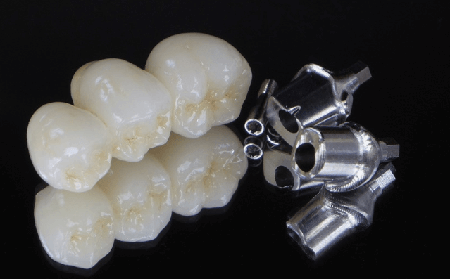 임플란트 보철재 비교 총정리 (Gold PFM Zirconia )