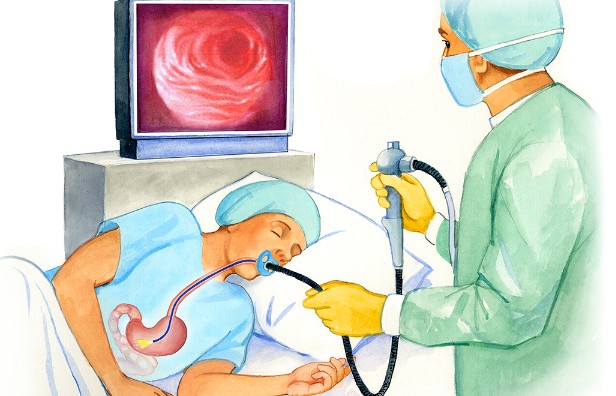 초기증상이 비슷한 위암, 위염, 역류성식도염 예방을 위해 위내시경은 필수