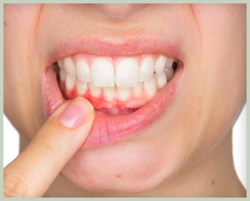 잇몸이 내려 앉을 때 치료 방법