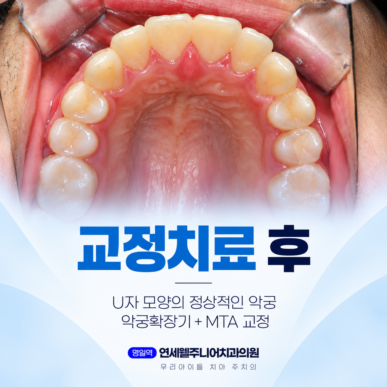 중학생 악궁확장기와 MTA 교정 후 U자 형태로 배열된 위턱 치열의 구강 내부 사진