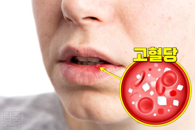 입이 마르는 이유, 당뇨병 전조증상, 팁줌