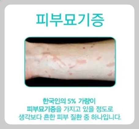 피부묘기증