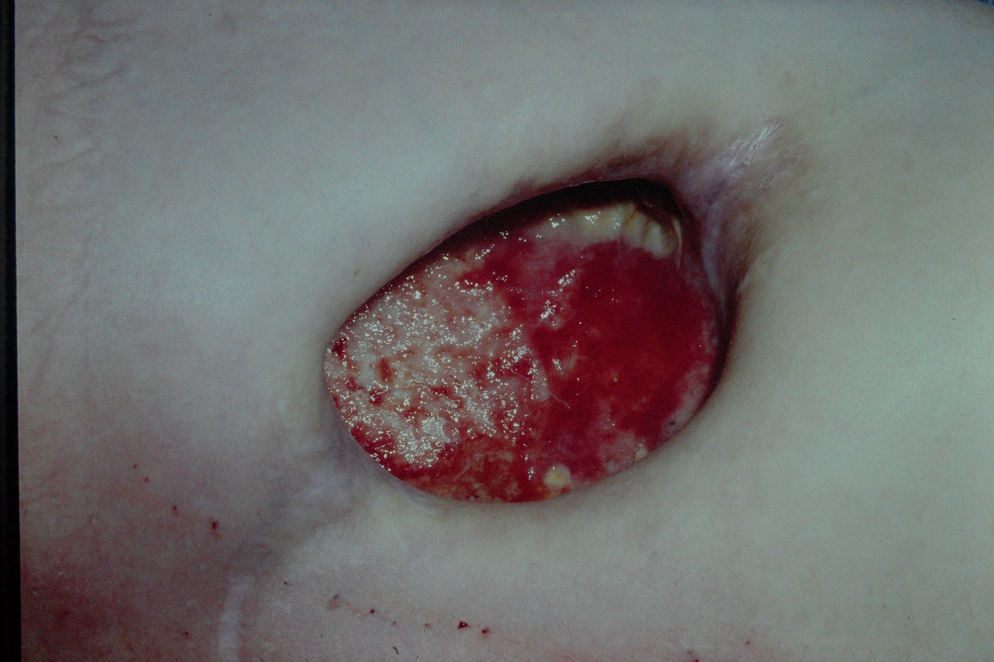 욕창이란? — 원인부터 단계별 증상까지 완벽 정리