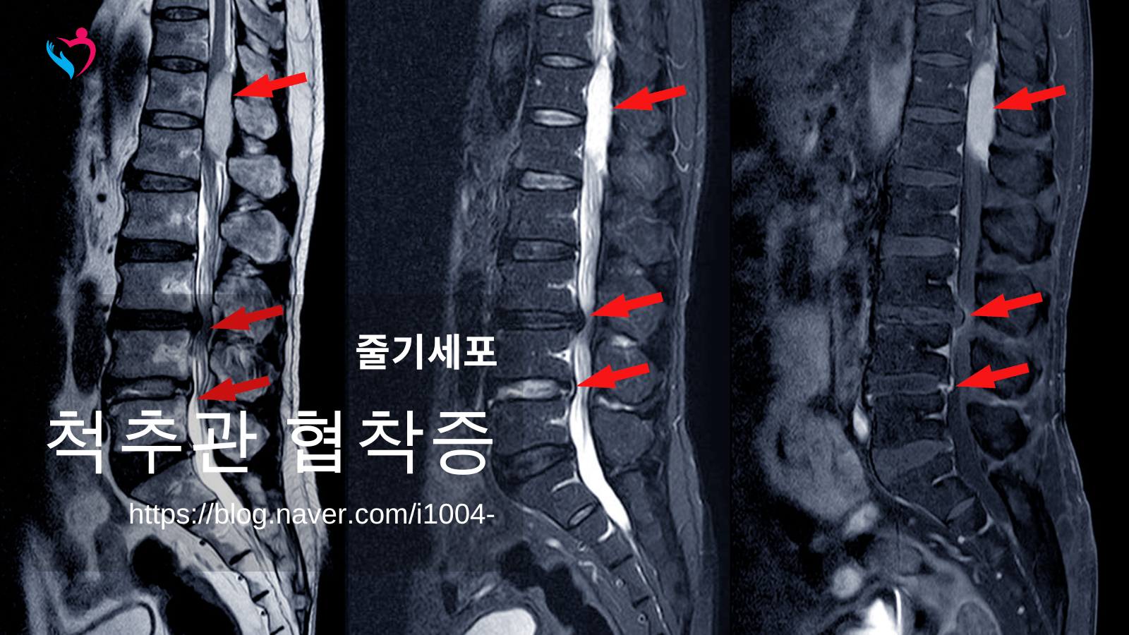 척추관 협착증 으로 인한 하지 근력 저하란?