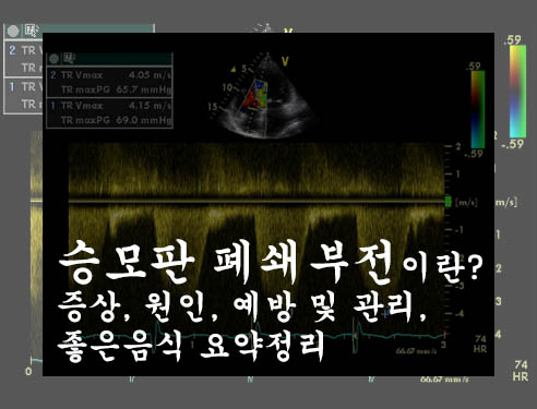 승모판 폐쇄부전 이란? 증상, 원인, 예방 및 관리, 좋은음식 요약정리