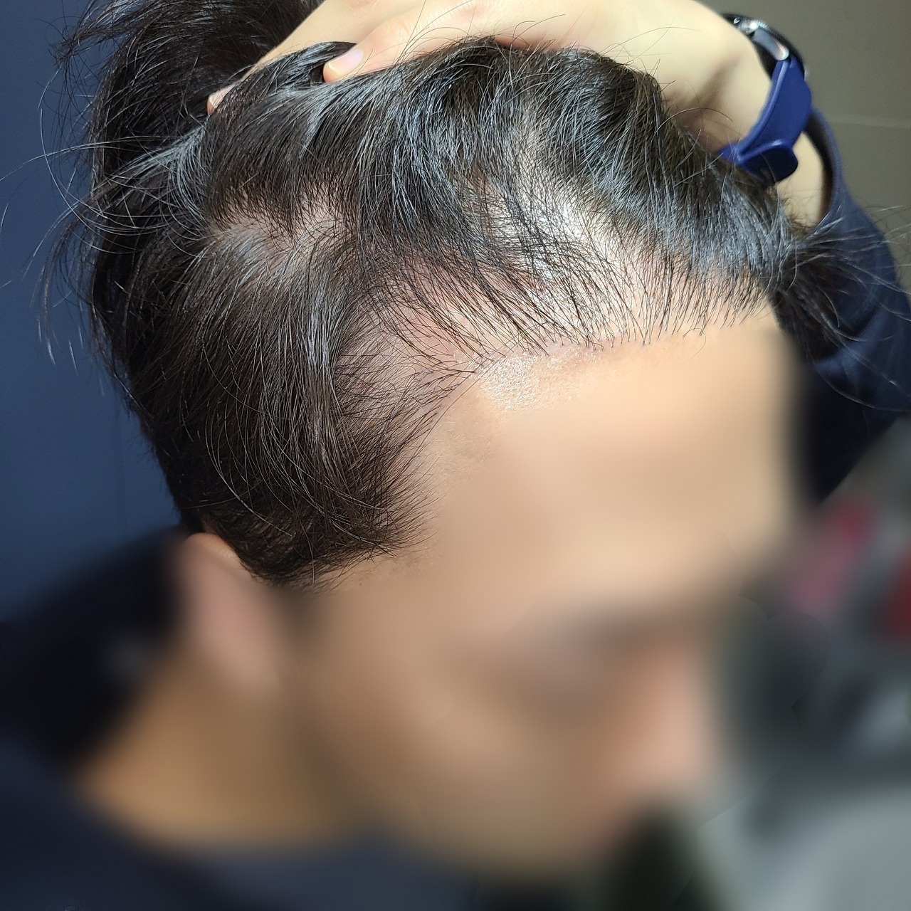 모발이식 후기
