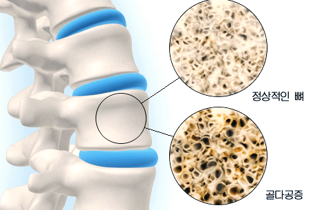콘드로이친 효능 부작용