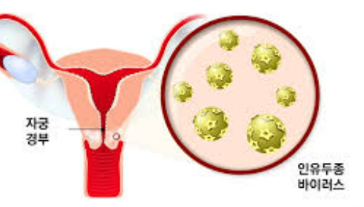 인유두종-바이러스