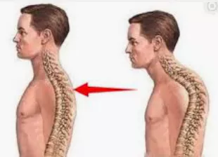 거북목-교정운동-거북목-증상-건강