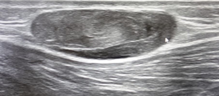 혈관종 초음파 영상