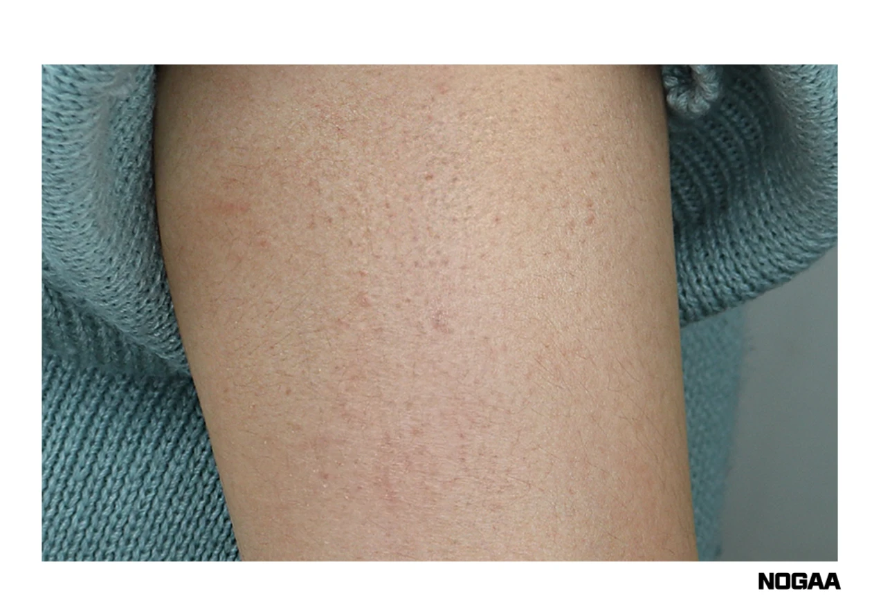 모공각화증 치료 방법