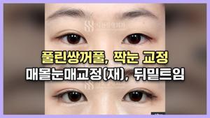 여자 무쌍 눈매 교정