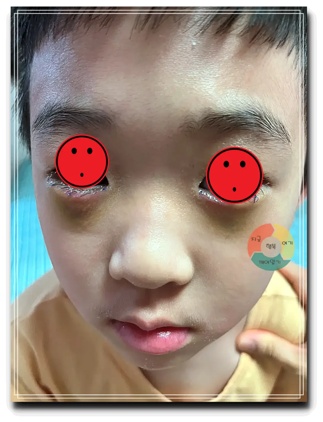 안검내반_수술 후 일주일-눈밑-멍