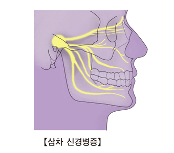 EBS 명의 삼차신경통 원인 증상 치료