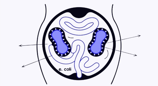 방광염치료과정