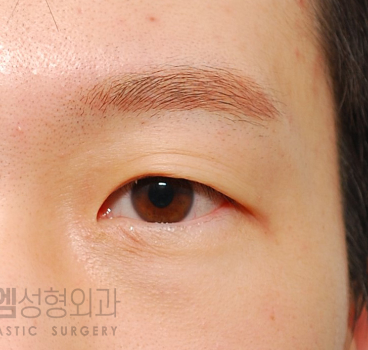 매몰 쌍꺼풀 풀림 증상