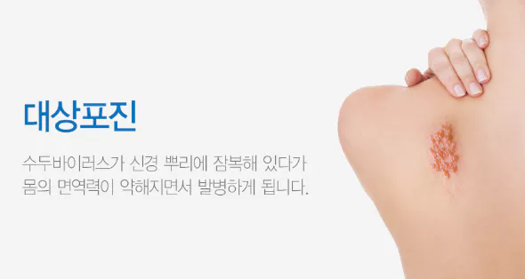 대상포진-정의