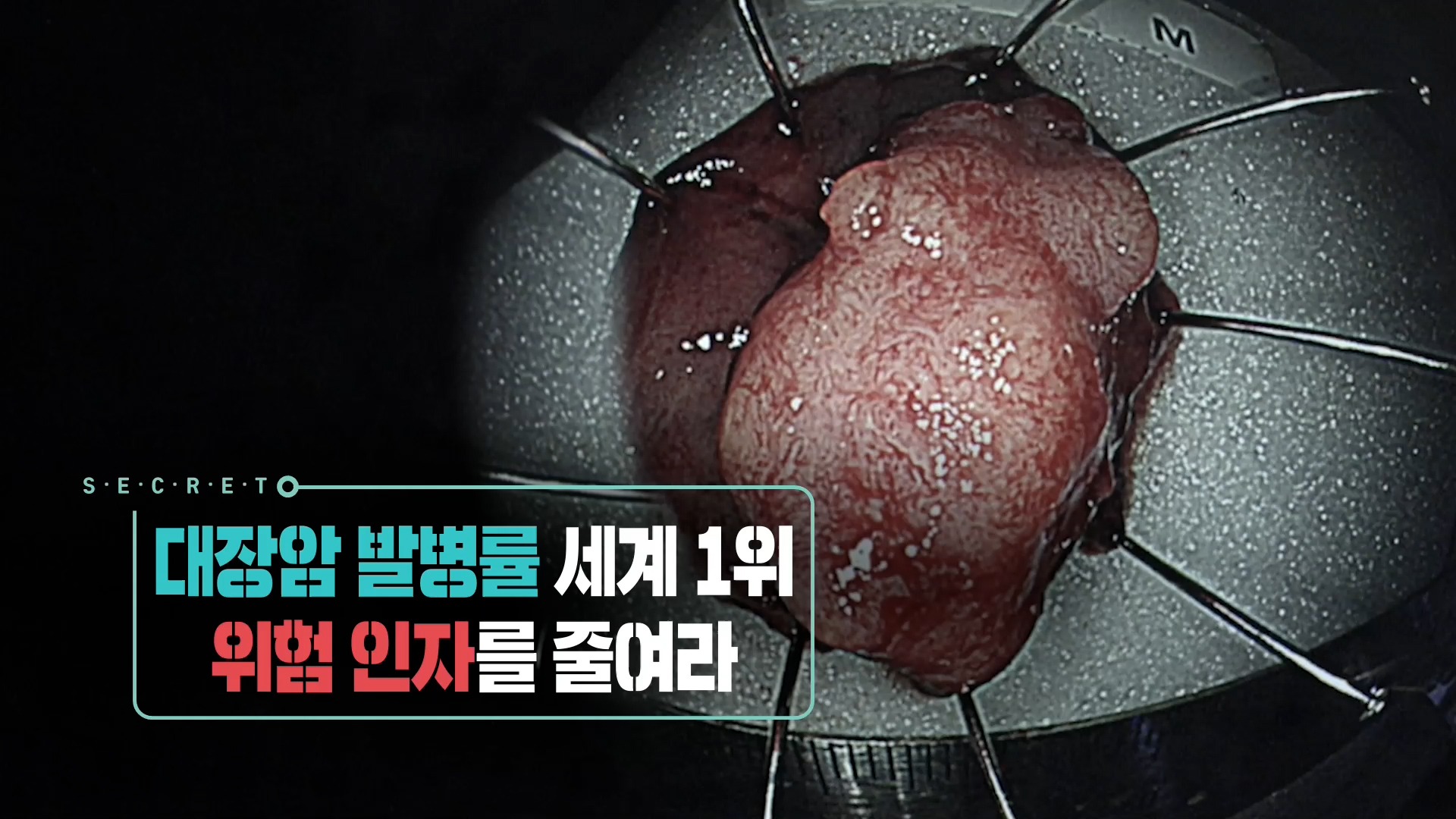 내장지방 체지방 염증 지방 돕는 수국잎 열수 추출물 대표 효능 3가지 및 부작용 알아보기