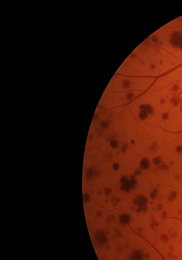 비문증 치료방법