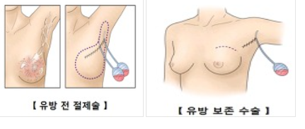 명의 유방암 증상 검사 명의추천