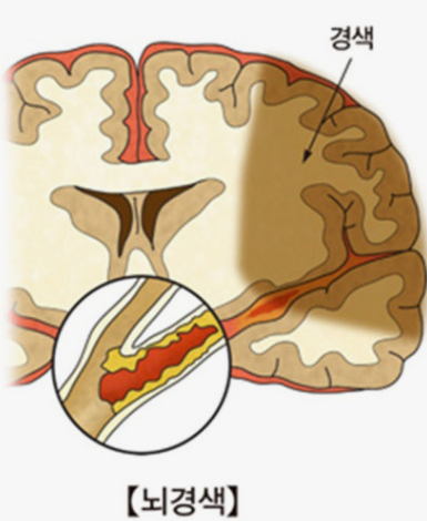 뇌경색 사진