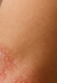 건선 피부염 완전정리