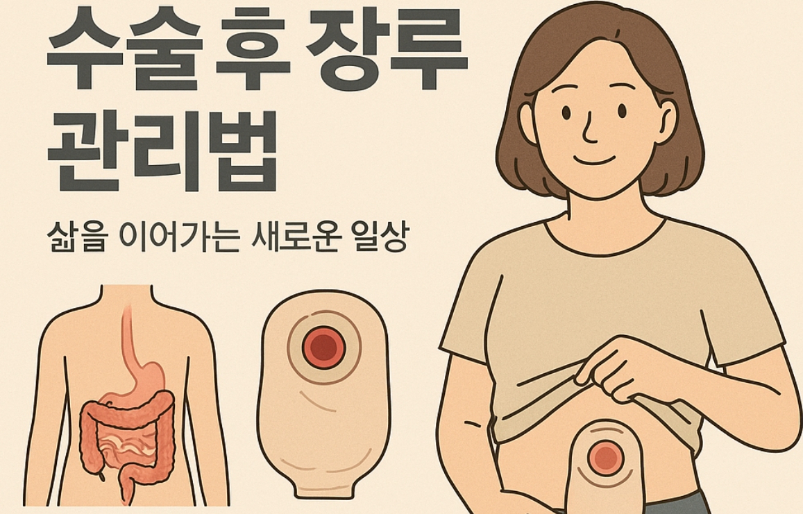대장암 수술후 장루 관리법